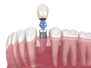 Elizabeth dental implants