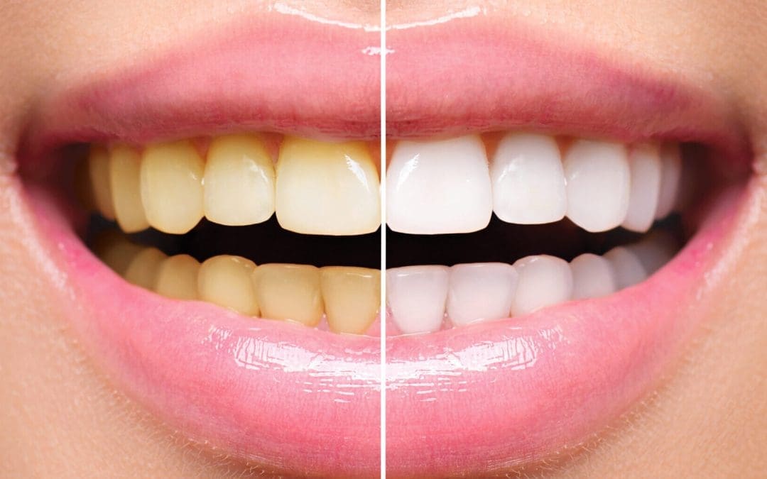 Teeth Whitening in Elizabeth, CO