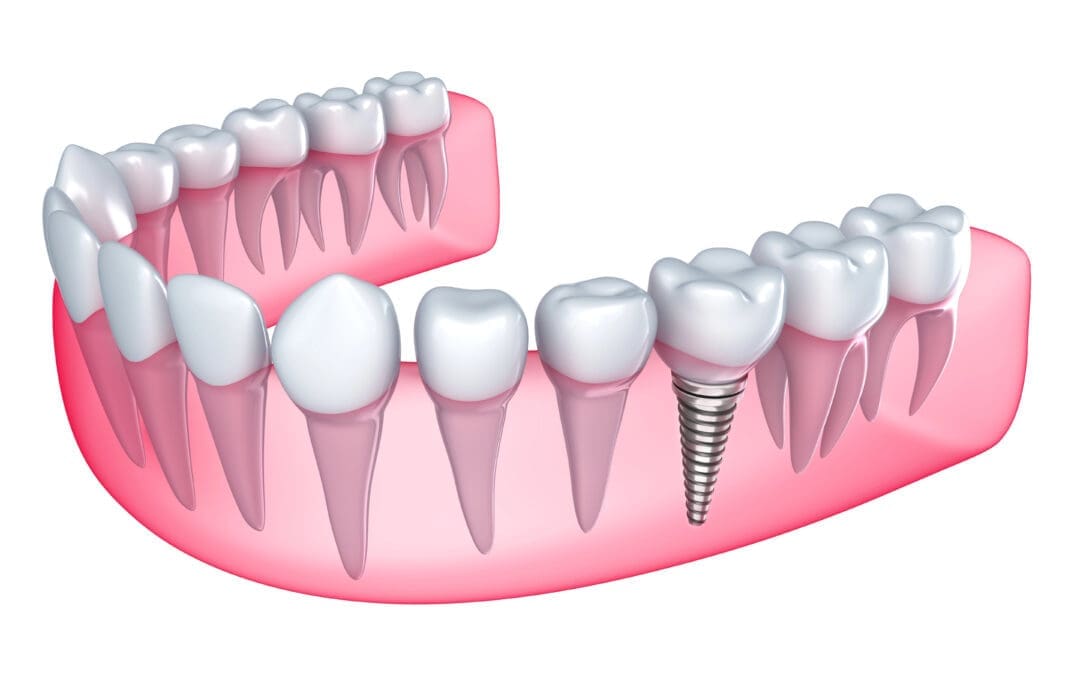 Screw in Teeth: A Permanent Solution for Missing Teeth