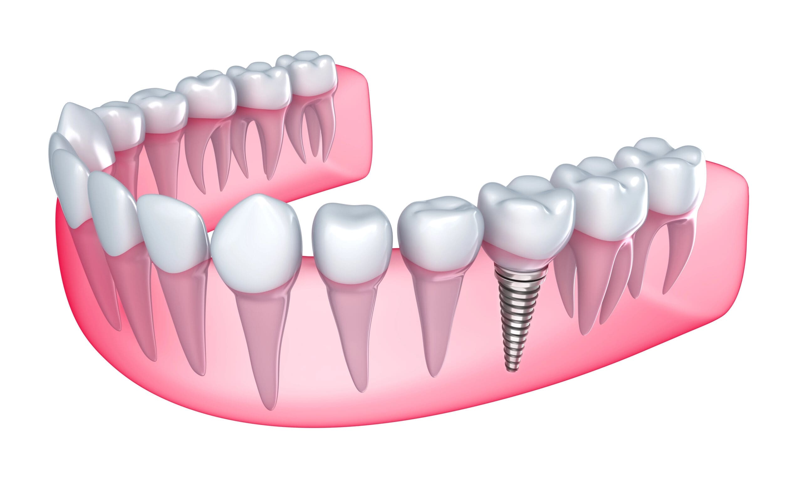 Explore lasting "screw in teeth" options for a confident smile at Timberline Family Dentistry in Elizabeth, CO. Call 303-646-3940.